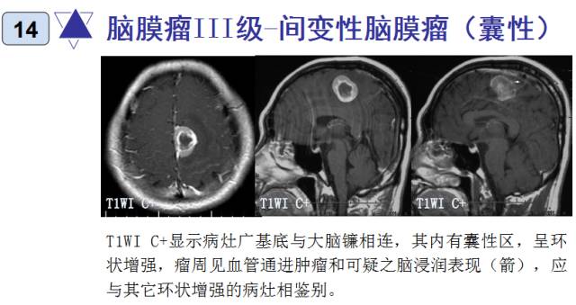 15种亚型脑膜瘤影像表现及诊断要点 15种亚型脑膜瘤影像表现及诊断要点