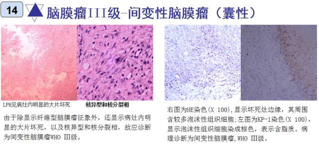 15种亚型脑膜瘤影像表现及诊断要点 15种亚型脑膜瘤影像表现及诊断要点