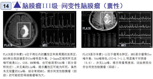 15种亚型脑膜瘤影像表现及诊断要点 15种亚型脑膜瘤影像表现及诊断要点
