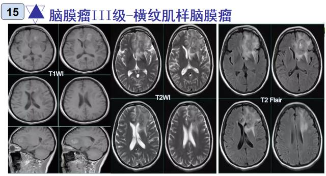 15种亚型脑膜瘤影像表现及诊断要点 15种亚型脑膜瘤影像表现及诊断要点