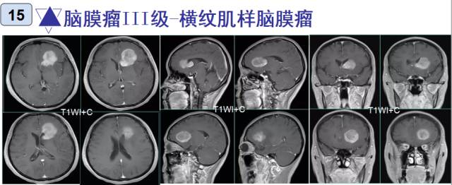 15种亚型脑膜瘤影像表现及诊断要点 15种亚型脑膜瘤影像表现及诊断要点