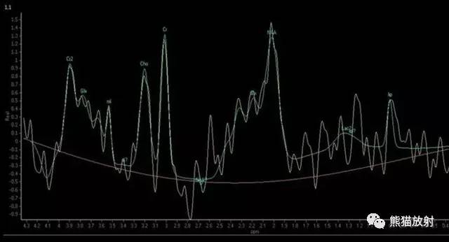 【病例】进行性多灶性白质脑病PML三例MR影像表现 【病例】进行性多灶性白质脑病PML三例MR影像表现
