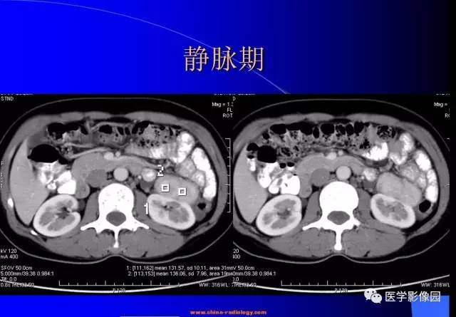 【病例】腹膜后平滑肌瘤1例CT影像表现 【病例】腹膜后平滑肌瘤1例CT影像表现