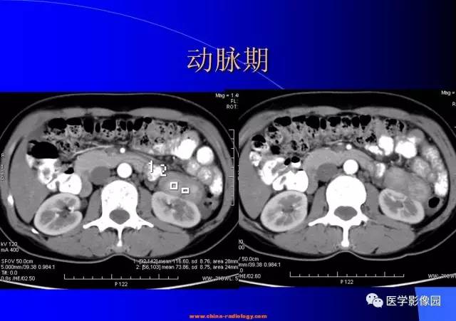 【病例】腹膜后平滑肌瘤1例CT影像表现 【病例】腹膜后平滑肌瘤1例CT影像表现