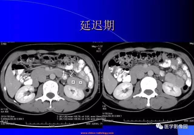【病例】腹膜后平滑肌瘤1例CT影像表现 【病例】腹膜后平滑肌瘤1例CT影像表现