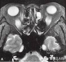 【病例】Graves眼病1例MR影像表现 【病例】Graves眼病1例MR影像表现