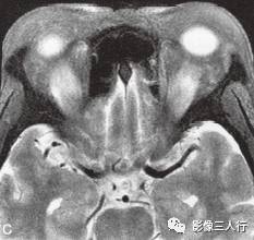 【病例】Graves眼病1例MR影像表现 【病例】Graves眼病1例MR影像表现