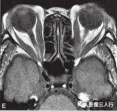 【病例】Graves眼病1例MR影像表现 【病例】Graves眼病1例MR影像表现