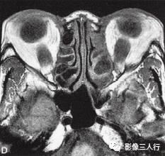 【病例】Graves眼病1例MR影像表现 【病例】Graves眼病1例MR影像表现