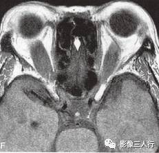【病例】Graves眼病1例MR影像表现 【病例】Graves眼病1例MR影像表现