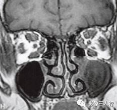 【病例】Graves眼病1例MR影像表现 【病例】Graves眼病1例MR影像表现