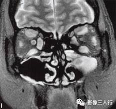 【病例】Graves眼病1例MR影像表现 【病例】Graves眼病1例MR影像表现