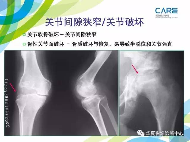 【PPT】骨肌系统影像学基本征象再认识