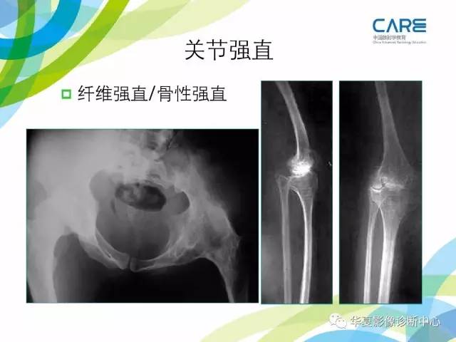 【PPT】骨肌系统影像学基本征象再认识