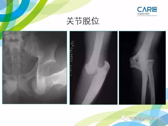 【PPT】骨肌系统影像学基本征象再认识