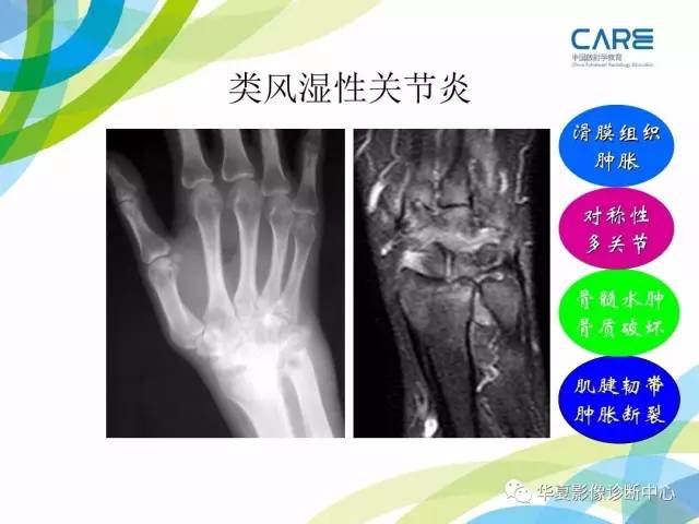 【PPT】骨肌系统影像学基本征象再认识