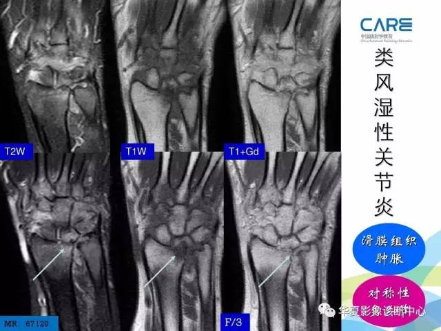 【PPT】骨肌系统影像学基本征象再认识