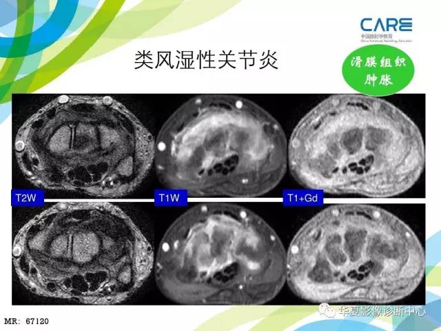 【PPT】骨肌系统影像学基本征象再认识