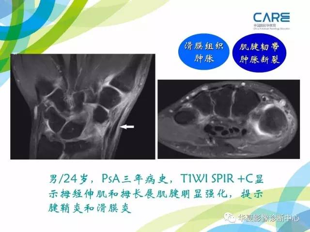 【PPT】骨肌系统影像学基本征象再认识