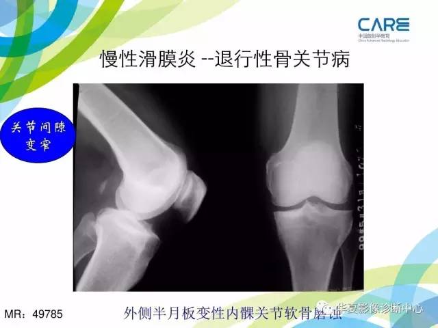 【PPT】骨肌系统影像学基本征象再认识
