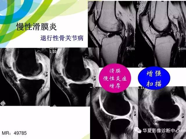 【PPT】骨肌系统影像学基本征象再认识