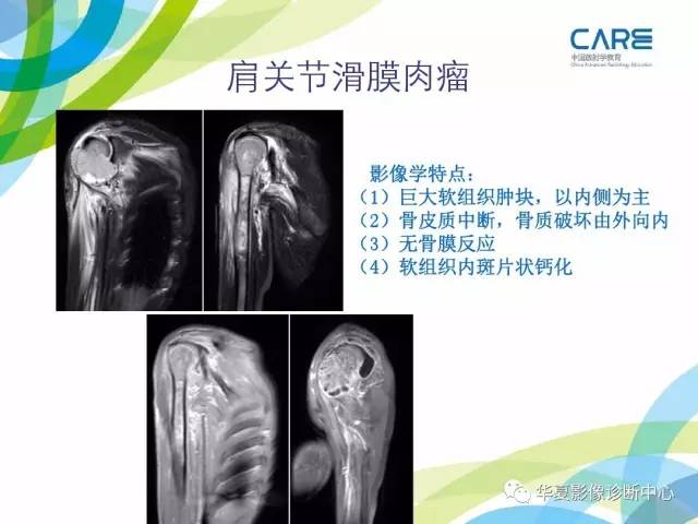 【PPT】骨肌系统影像学基本征象再认识