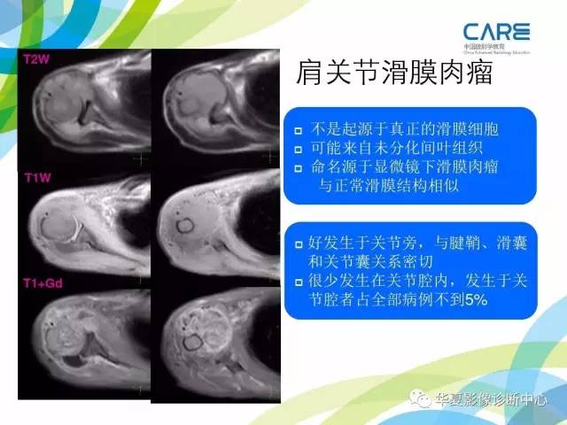 【PPT】骨肌系统影像学基本征象再认识