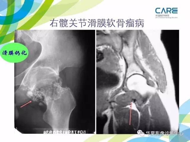 【PPT】骨肌系统影像学基本征象再认识