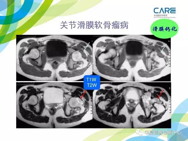 【PPT】骨肌系统影像学基本征象再认识