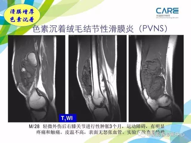 【PPT】骨肌系统影像学基本征象再认识