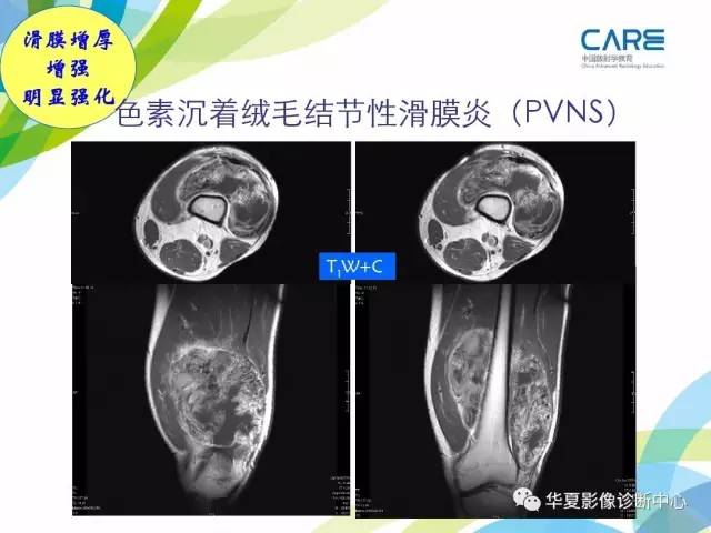 【PPT】骨肌系统影像学基本征象再认识