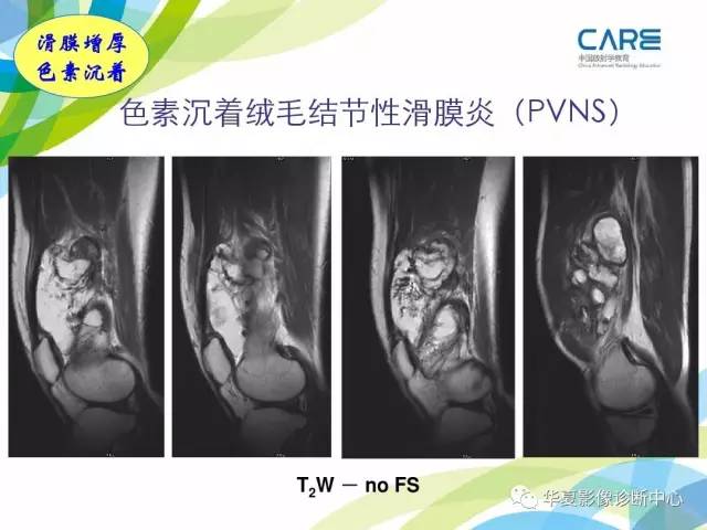 【PPT】骨肌系统影像学基本征象再认识