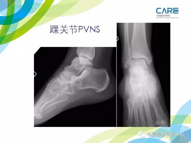 【PPT】骨肌系统影像学基本征象再认识