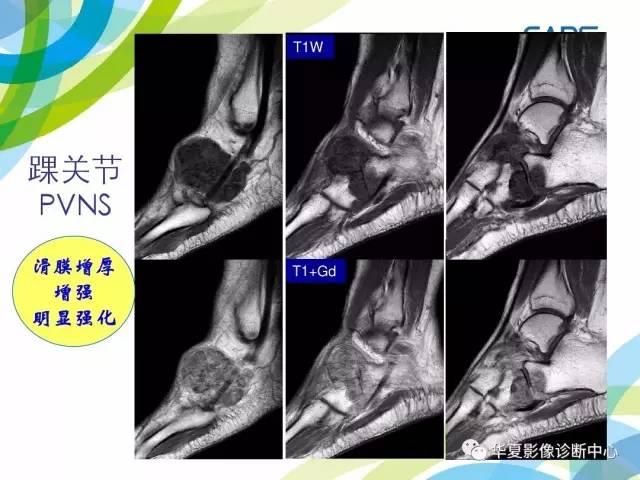 【PPT】骨肌系统影像学基本征象再认识