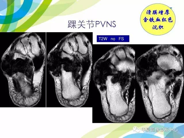 【PPT】骨肌系统影像学基本征象再认识