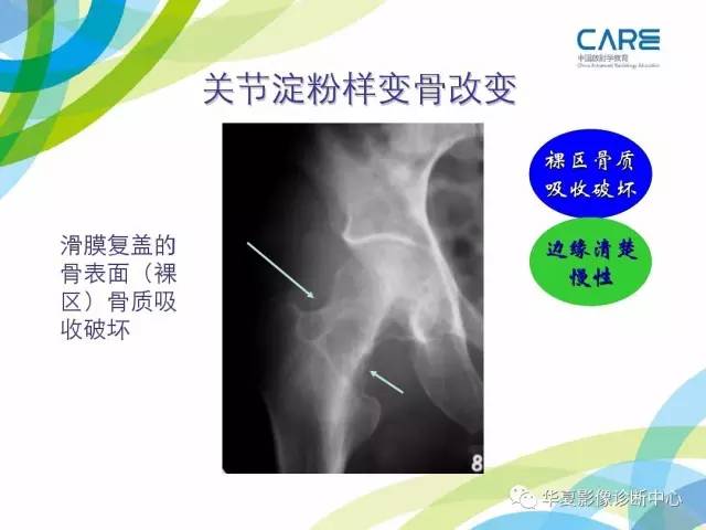 【PPT】骨肌系统影像学基本征象再认识