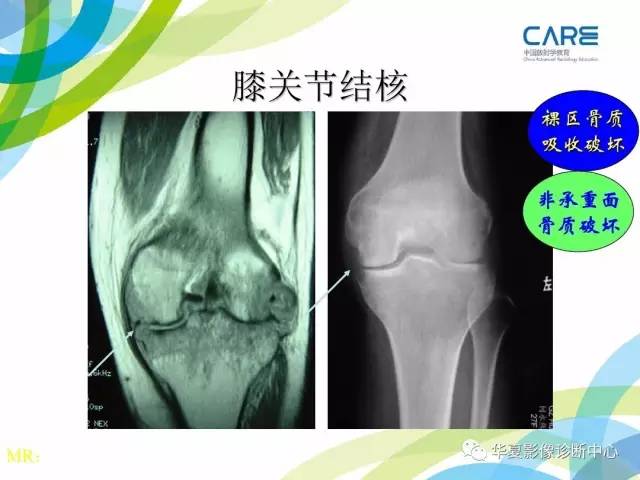 【PPT】骨肌系统影像学基本征象再认识