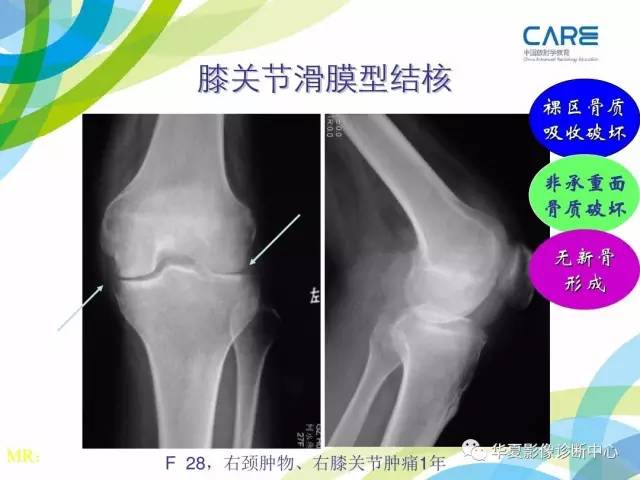 【PPT】骨肌系统影像学基本征象再认识