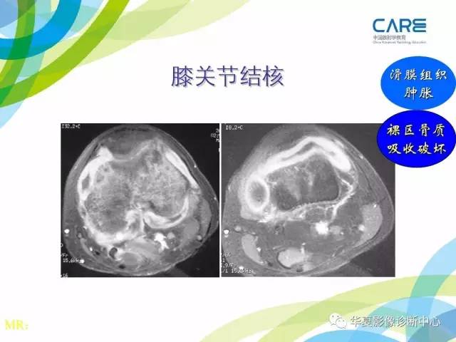 【PPT】骨肌系统影像学基本征象再认识