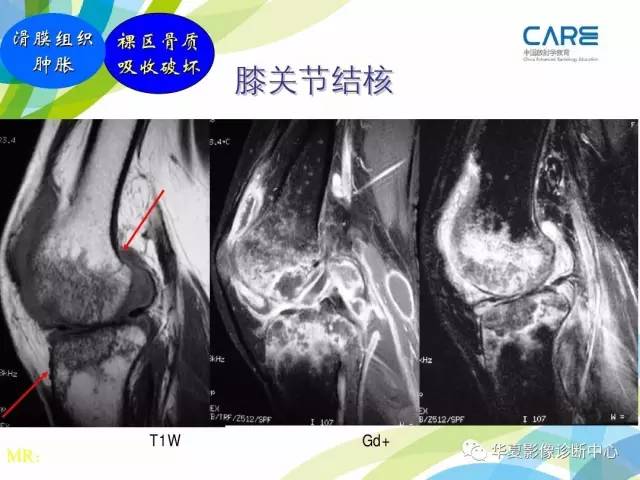 【PPT】骨肌系统影像学基本征象再认识