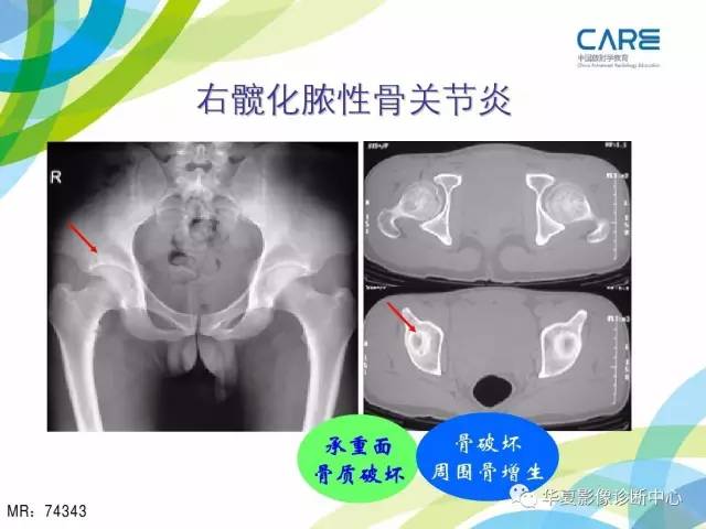 【PPT】骨肌系统影像学基本征象再认识