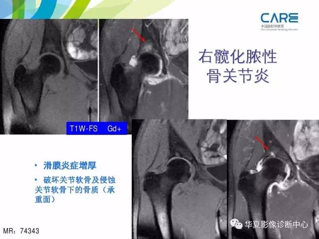 【PPT】骨肌系统影像学基本征象再认识