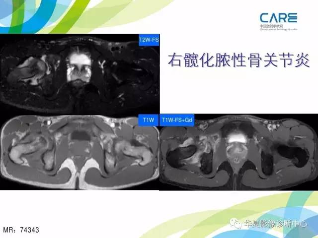 【PPT】骨肌系统影像学基本征象再认识