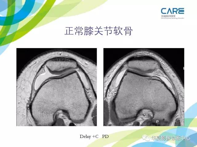 【PPT】骨肌系统影像学基本征象再认识