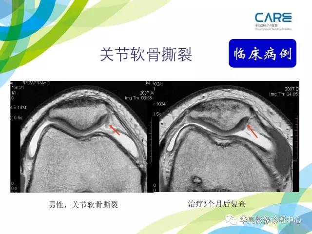 【PPT】骨肌系统影像学基本征象再认识