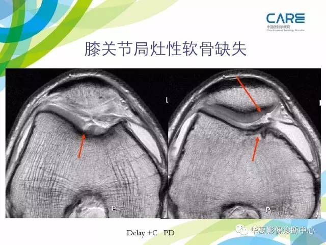 【PPT】骨肌系统影像学基本征象再认识