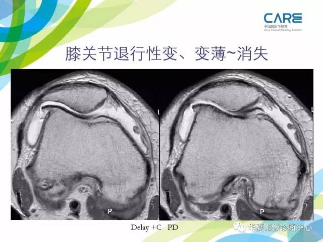【PPT】骨肌系统影像学基本征象再认识