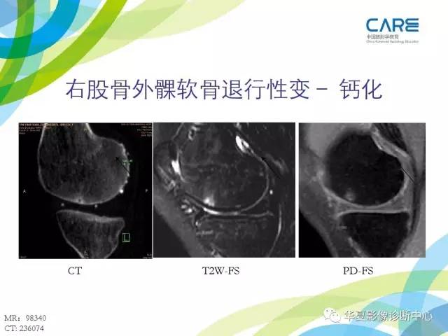 【PPT】骨肌系统影像学基本征象再认识