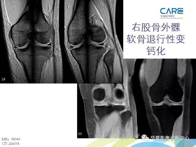 【PPT】骨肌系统影像学基本征象再认识