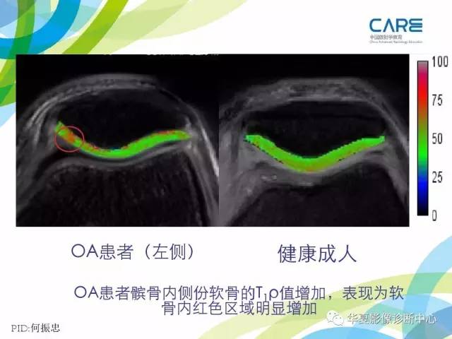 【PPT】骨肌系统影像学基本征象再认识